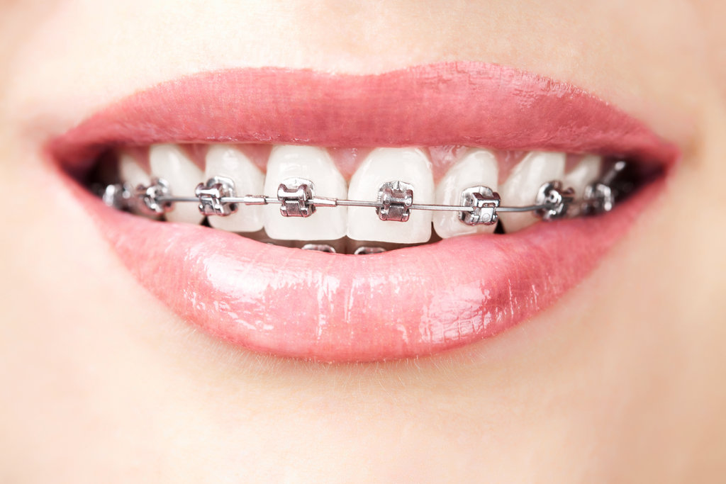 Braces